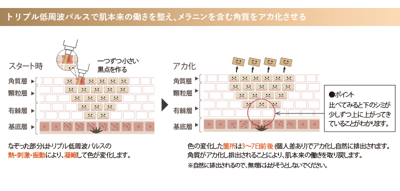 トリプル低周波パルスで肌本来の働きを整え、メラニンを含む角質をアカ化させる